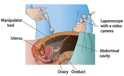 iui treatment